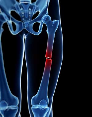 Neocate Bone Fracture